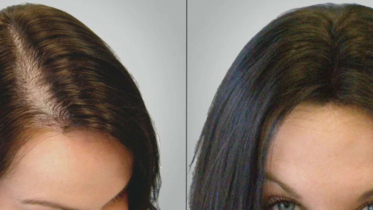 Biosoprolol et perte de cheveux : existe-t-il un lien ?