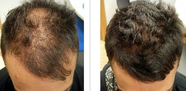 Finasteride vs Minoxidil : Quel est le meilleur traitement contre la perte de cheveux ?