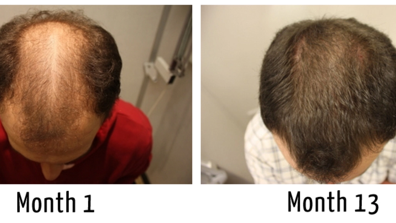 Minoxidil Topique et Prévention de la Perte de Cheveux: Conseils pour le Succès